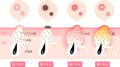 ニキビの種類と症状