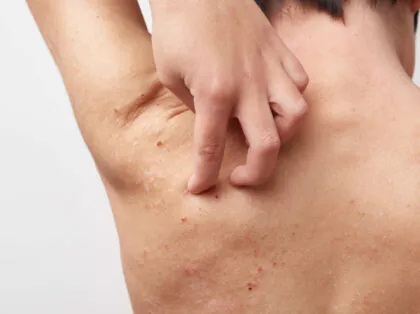 アトピー性皮膚炎の原因は？